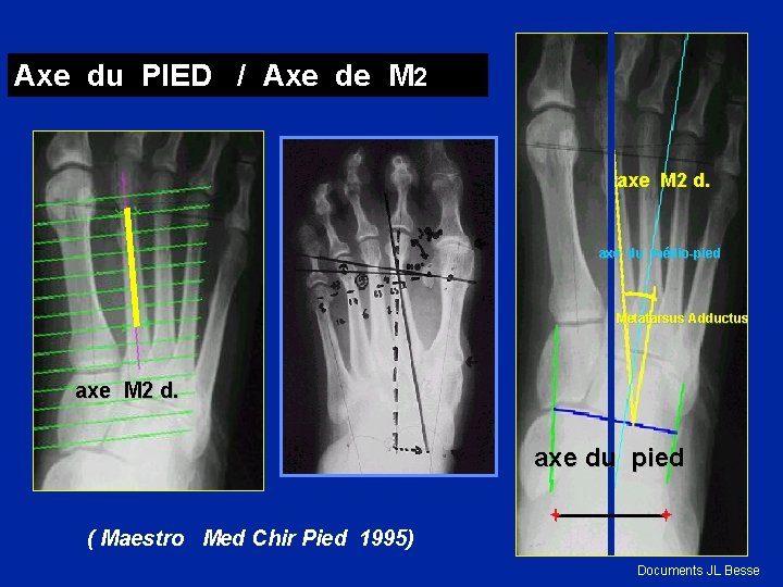 Axe du PIED / Axe de M 2 axe M 2 d. axe du