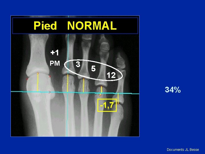 Pied NORMAL +1 PM 3 5 12 34% -1, 7 Documents JL Besse 