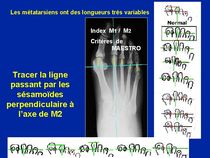 Les métatarsiens ont des longueurs très variables Index M 1 / M 2 Critères
