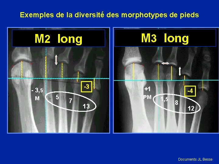 Exemples de la diversité des morphotypes de pieds M 3 long M 2 long