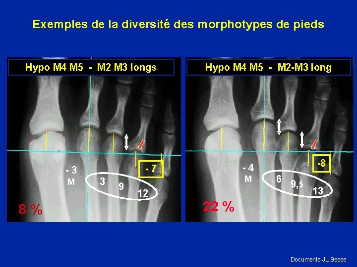 Exemples de la diversité des morphotypes de pieds Hypo M 4 M 5 -