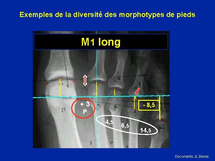 Exemples de la diversité des morphotypes de pieds M 1 long + 3 -