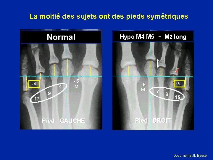 La moitié des sujets ont des pieds symétriques Normal - 4 17 4 -