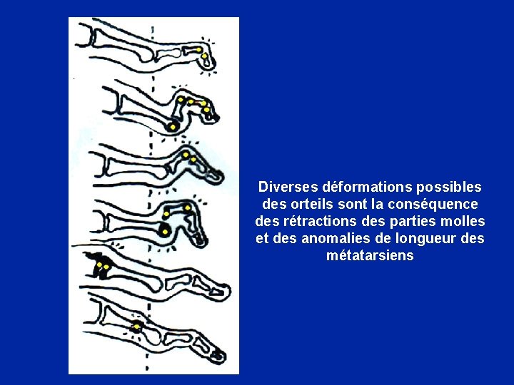 Diverses déformations possibles des orteils sont la conséquence des rétractions des parties molles et