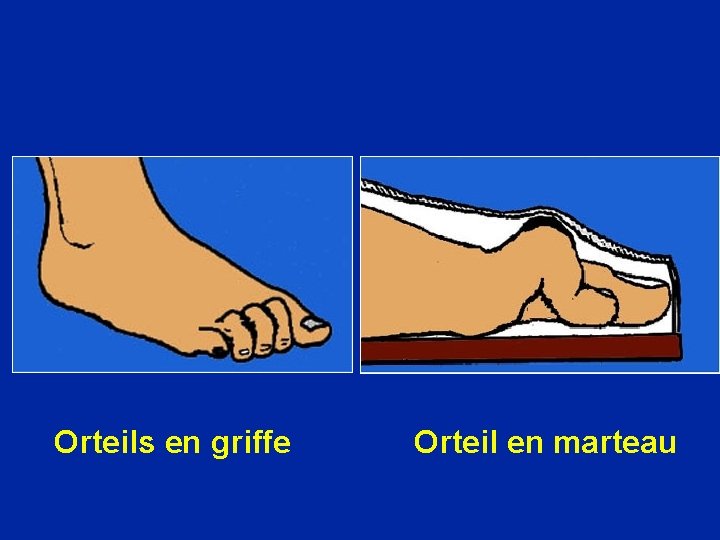 Orteils en griffe Orteil en marteau 