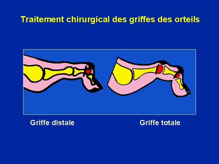 Traitement chirurgical des griffes des orteils Griffe distale Griffe totale 