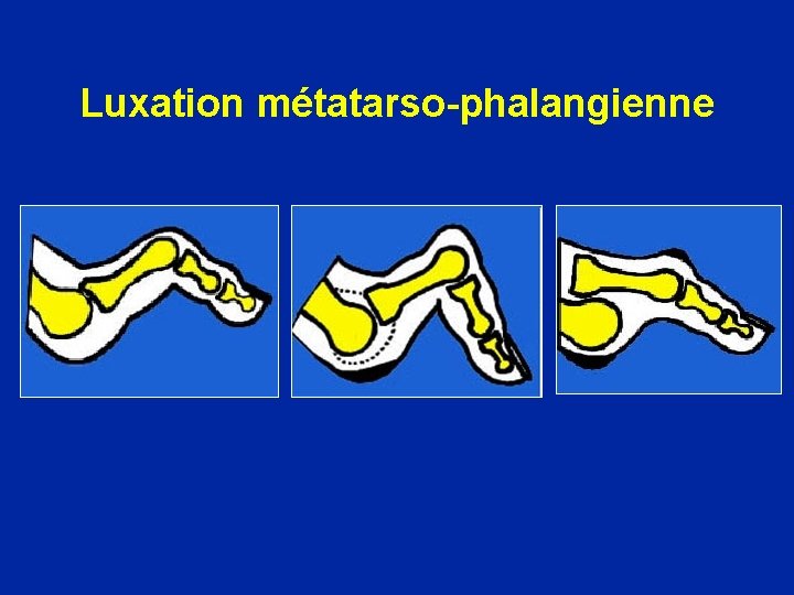 Luxation métatarso-phalangienne 