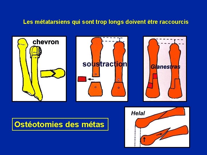 Les métatarsiens qui sont trop longs doivent être raccourcis Ostéotomies des métas 
