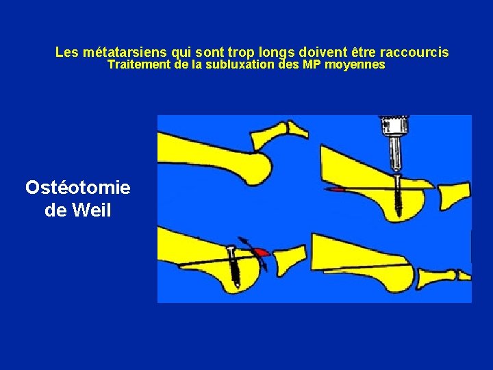 Les métatarsiens qui sont trop longs doivent être raccourcis Traitement de la subluxation des
