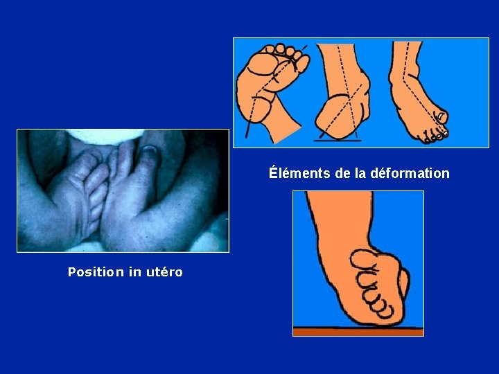 Éléments de la déformation Position in utéro 