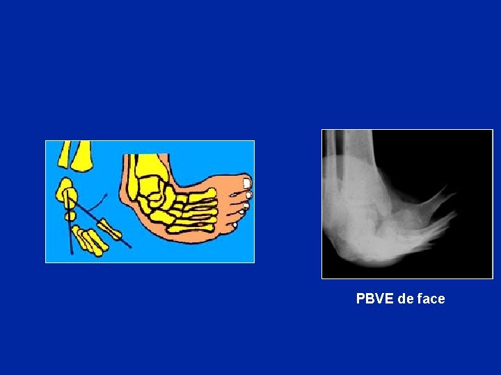 PBVE de face 
