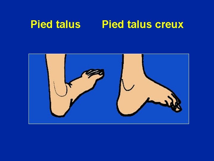 Pied talus creux 
