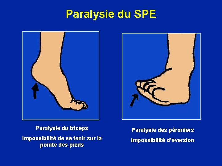 Paralysie du SPE Paralysie du triceps Paralysie des péroniers Impossibilité de se tenir sur