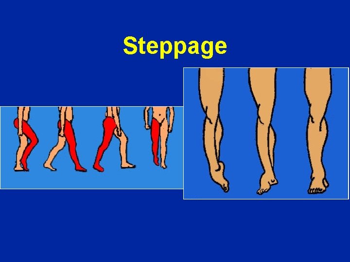 Steppage 