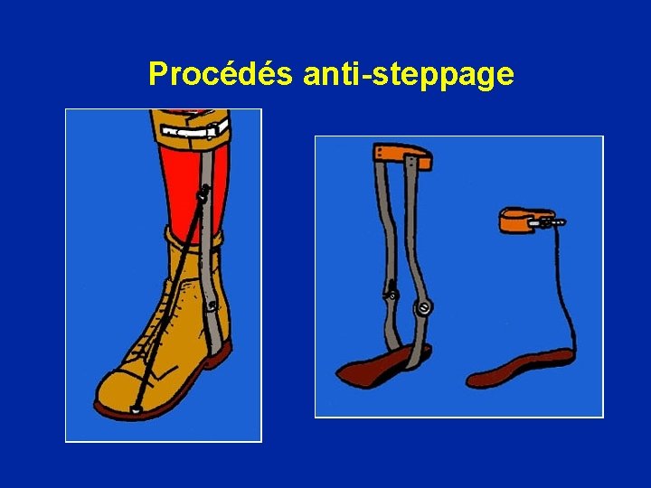 Procédés anti-steppage 