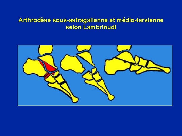 Arthrodèse sous-astragalienne et médio-tarsienne selon Lambrinudi 