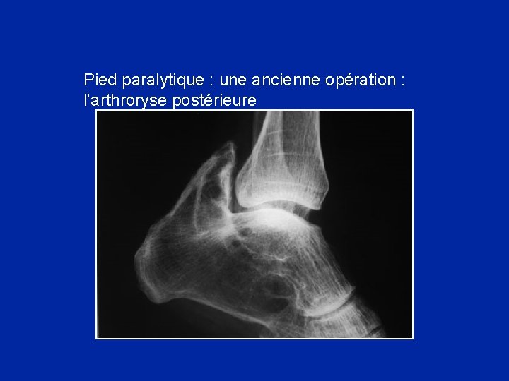 Pied paralytique : une ancienne opération : l’arthroryse postérieure 