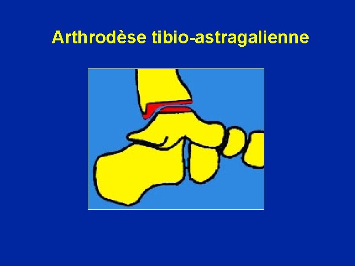 Arthrodèse tibio-astragalienne 