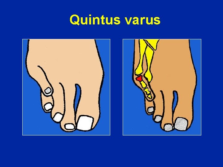Quintus varus 