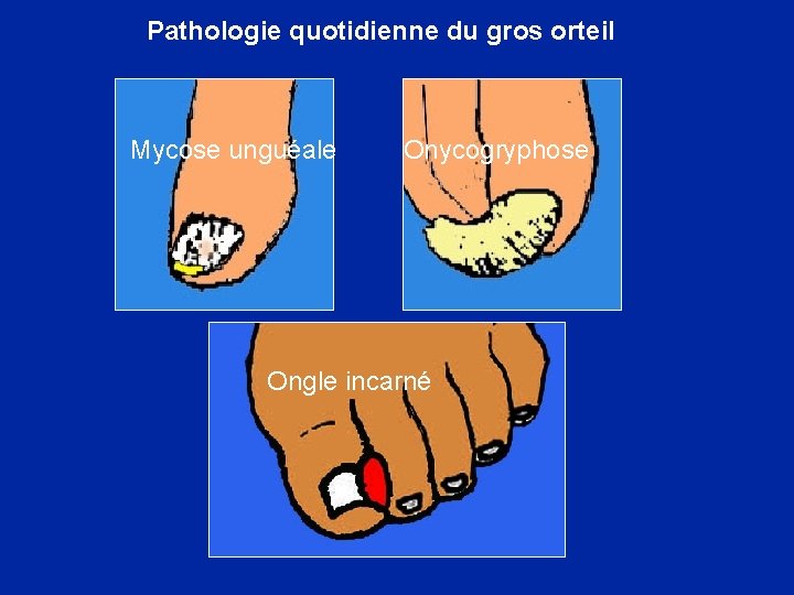 Pathologie quotidienne du gros orteil Mycose unguéale Onycogryphose Ongle incarné 