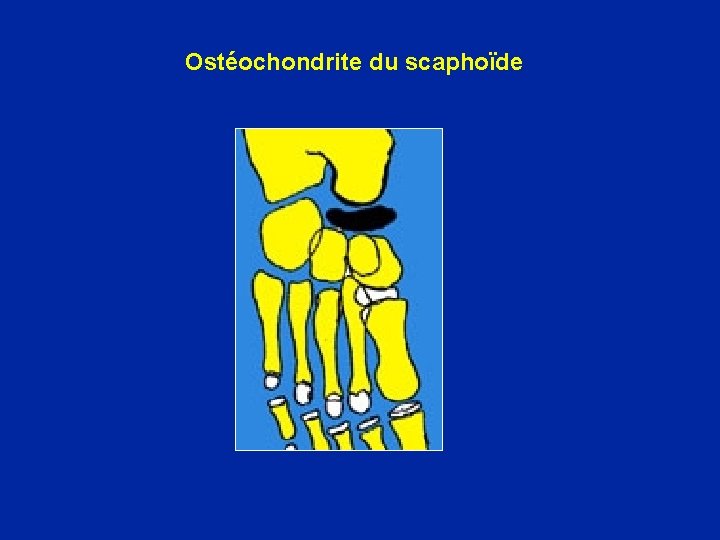 Ostéochondrite du scaphoïde 