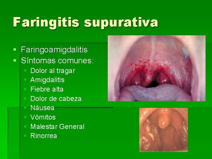 Faringitis supurativa § Faringoamigdalitis § Síntomas comunes: § § § § Dolor al tragar