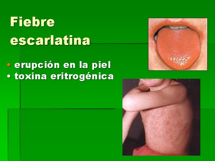 Fiebre escarlatina • erupción en la piel • toxina eritrogénica 