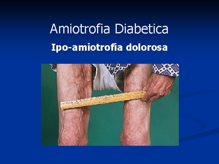 Amiotrofia Diabetica Ipo-amiotrofia dolorosa Amiotrofia Diabetica Ipo-amiotrofia dolorosa