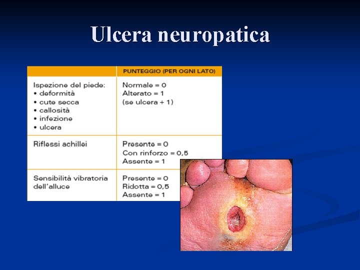 Ulcera neuropatica Ulcera neuropatica