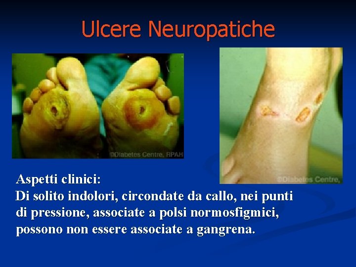 Ulcere Neuropatiche Aspetti clinici: Di solito indolori, circondate da callo, nei punti di pressione, Ulcere Neuropatiche Aspetti clinici: Di solito indolori, circondate da callo, nei punti di pressione,