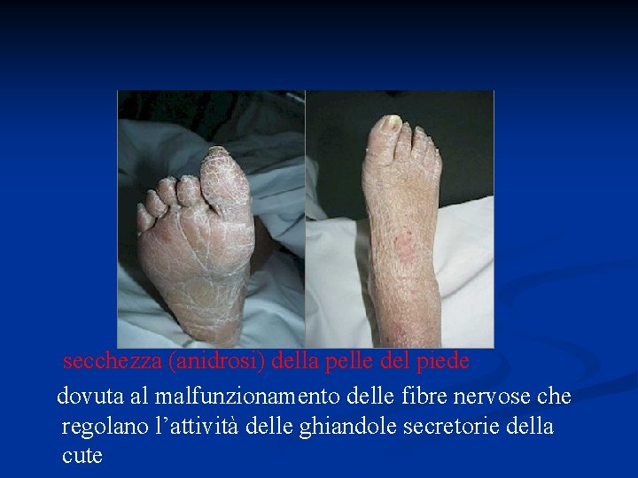 secchezza (anidrosi) della pelle del piede dovuta al malfunzionamento delle fibre nervose che regolano secchezza (anidrosi) della pelle del piede dovuta al malfunzionamento delle fibre nervose che regolano