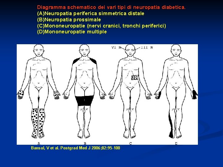 Diagramma schematico dei vari tipi di neuropatia diabetica. (A)Neuropatia periferica simmetrica distale (B)Neuropatia prossimale Diagramma schematico dei vari tipi di neuropatia diabetica. (A)Neuropatia periferica simmetrica distale (B)Neuropatia prossimale
