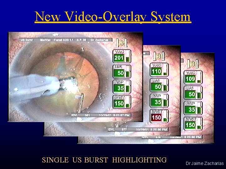 New Video-Overlay System SINGLE US BURST HIGHLIGHTING Dr Jaime Zacharias 