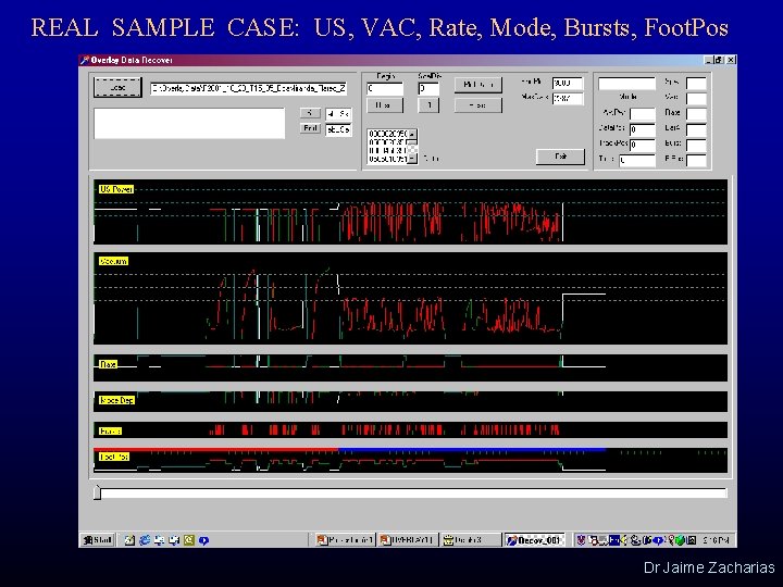 REAL SAMPLE CASE: US, VAC, Rate, Mode, Bursts, Foot. Pos Dr Jaime Zacharias 