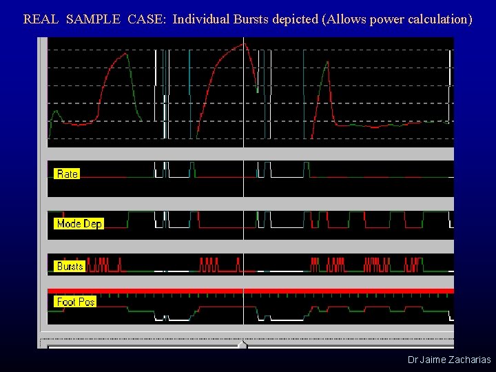 REAL SAMPLE CASE: Individual Bursts depicted (Allows power calculation) Dr Jaime Zacharias 