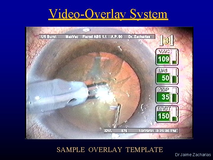 Video-Overlay System SAMPLE OVERLAY TEMPLATE Dr Jaime Zacharias 