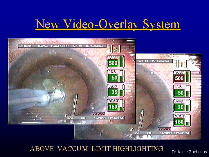 New Video-Overlay System ABOVE VACCUM LIMIT HIGHLIGHTING Dr Jaime Zacharias 