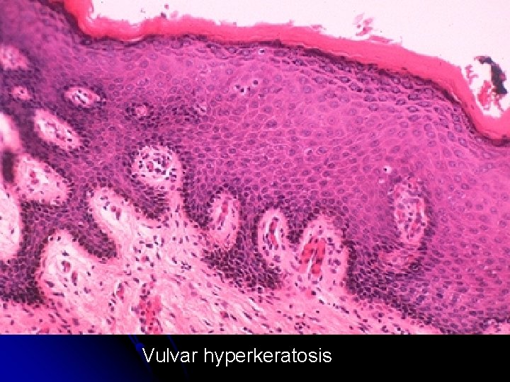 Vulvar hyperkeratosis 