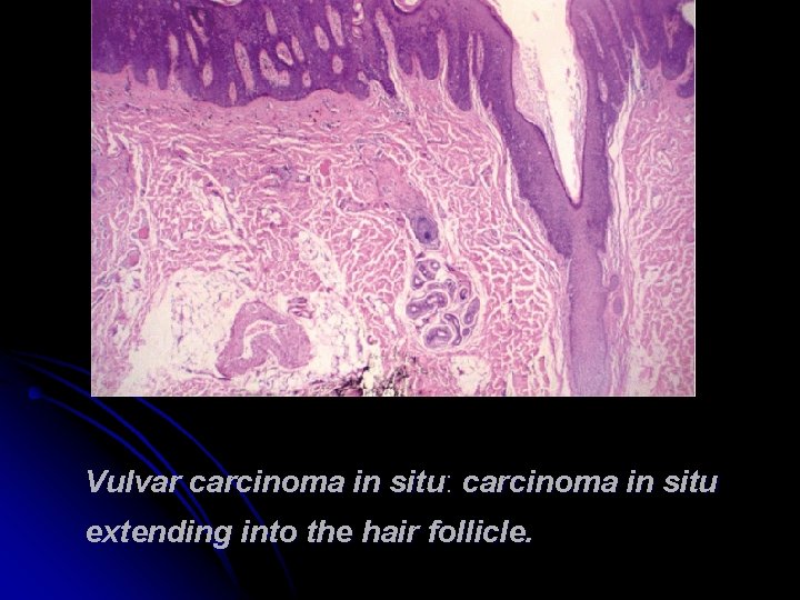 Vulvar carcinoma in situ: carcinoma in situ extending into the hair follicle. 