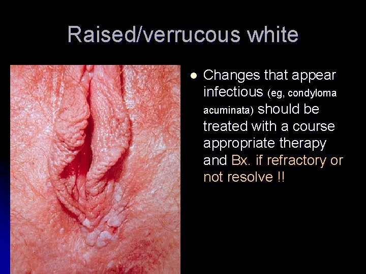 condilom pe vulva care specialist tratează papilomele