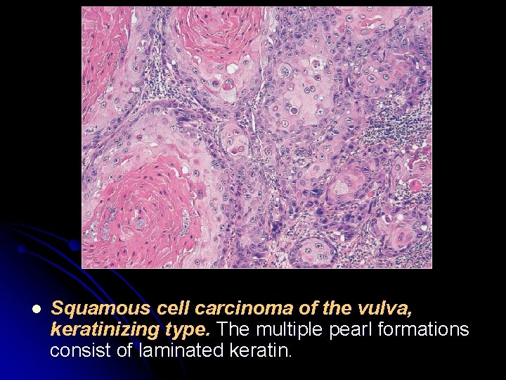 l Squamous cell carcinoma of the vulva, keratinizing type. The multiple pearl formations consist