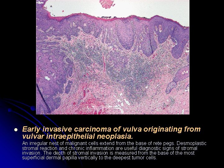 l Early invasive carcinoma of vulva originating from vulvar intraepithelial neoplasia. An irregular nest