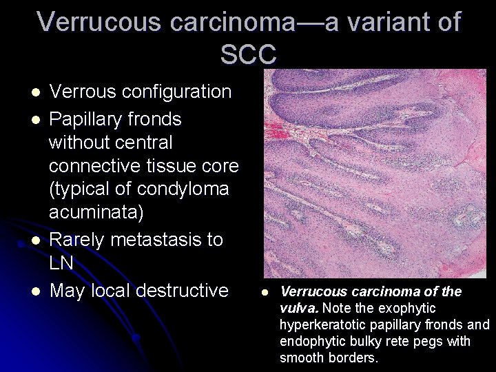 Verrucous carcinoma—a variant of SCC l l Verrous configuration Papillary fronds without central connective