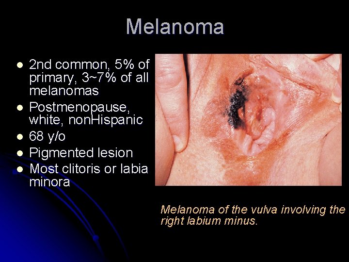 Melanoma l l l 2 nd common, 5% of primary, 3~7% of all melanomas