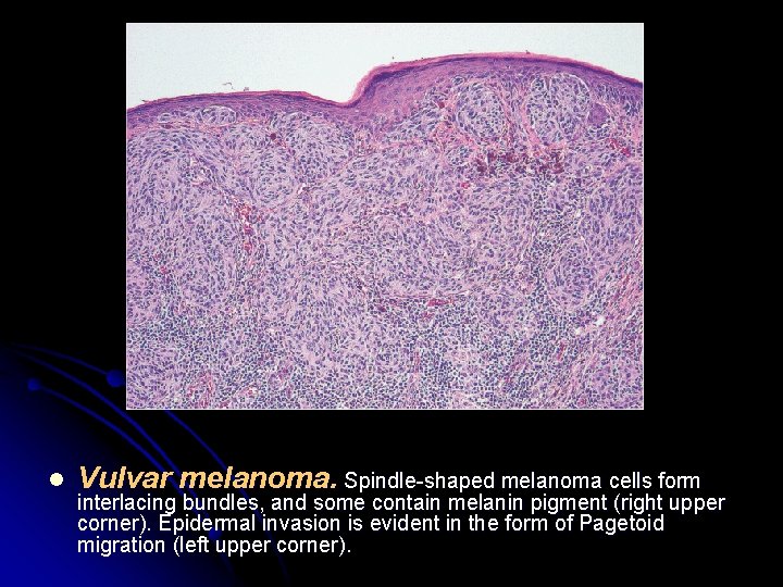 l Vulvar melanoma. Spindle-shaped melanoma cells form interlacing bundles, and some contain melanin pigment