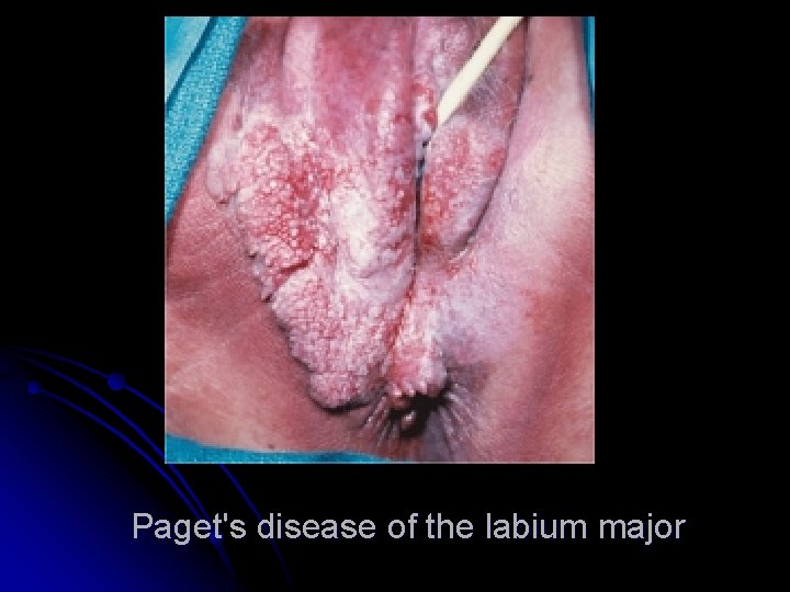 Paget's disease of the labium major 