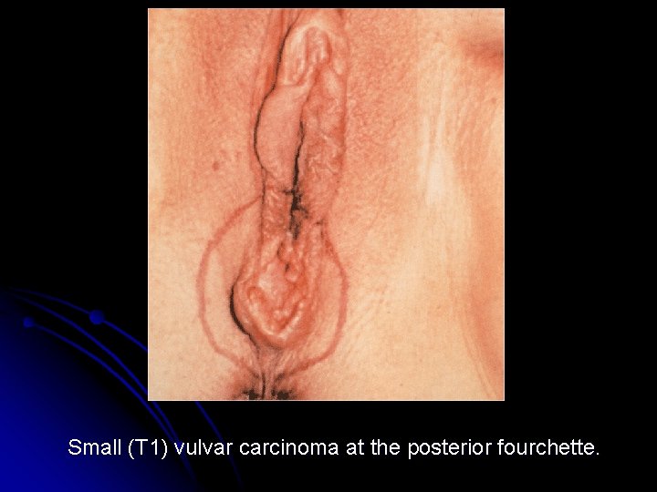 Small (T 1) vulvar carcinoma at the posterior fourchette. 