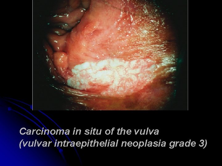 Carcinoma in situ of the vulva (vulvar intraepithelial neoplasia grade 3) 