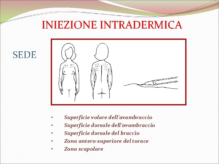 INIEZIONE INTRADERMICA SEDE • • • Superficie volare dell’avambraccio Superficie dorsale del braccio Zona