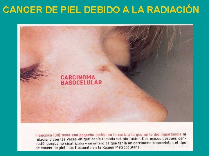 CANCER DE PIEL DEBIDO A LA RADIACIÓN 
